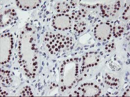 IHC of paraffin-embedded Carcinoma of Human thyroid tissue using anti-ANKRD53 mouse monoclonal antibody.