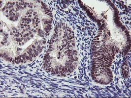 IHC of paraffin-embedded Adenocarcinoma of Human endometrium tissue using anti-ANKRD53 mouse monoclonal antibody.