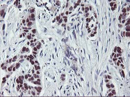IHC of paraffin-embedded Carcinoma of Human lung tissue using anti-ANKRD53 mouse monoclonal antibody.