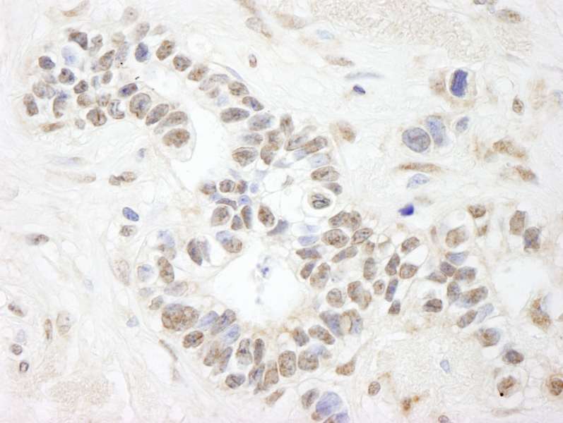 Detection of Human ANKS3 by Immunohistochemistry. Sample: FFPE section of human breast carcinoma. Antibody: Affinity purified rabbit anti-ANKS3 used at a dilution of 1:250.