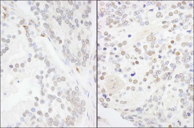 Detection of Human and Mouse ANKS3 by Immunohistochemistry. Sample: FFPE section of human prostate carcinoma (left) and mouse teratoma (right). Antibody: Affinity purified rabbit anti-ANKS3 used at a dilution of 1:1000 (1 ug/ml).