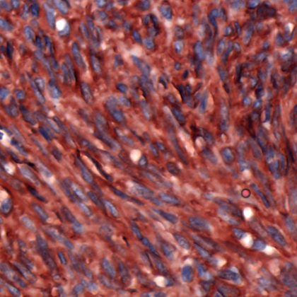 Immunohistochemistry of Human Gastrointestinal Stromal Tumor stained with anti-DOG-1 antibody