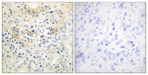 IHC of paraffin-embedded human prostate carcinoma tissue, using TM16G Antibody. The picture on the right is treated with the synthesized peptide.