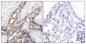 IHC of paraffin-embedded human breast carcinoma, using Abl (Phospho-Tyr393/412) Antibody. The picture on the right is treated with the synthesized peptide.