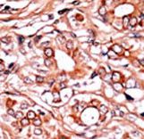Formalin-fixed and paraffin-embedded human cancer tissue reacted with the primary antibody, which was peroxidase-conjugated to the secondary antibody, followed by AEC staining. This data demonstrates the use of this antibody for immunohistochemistry; clinical relevance has not been evaluated. BC = breast carcinoma; HC = hepatocarcinoma.