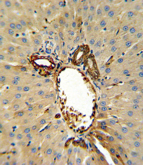 Annexin V Antibody IHC of formalin-fixed and paraffin-embedded human hepatocarcinoma followed by peroxidase-conjugated secondary antibody and DAB staining. This data demonstrates the use of the Annexin V Antibody for immunohistochemistry.