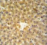 Annexin V Antibody IHC of formalin-fixed and paraffin-embedded human hepatocarcinoma followed by peroxidase-conjugated secondary antibody and DAB staining. This data demonstrates the use of the Annexin V Antibody for immunohistochemistry.