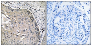 IHC of paraffin-embedded human lung carcinoma tissue, using AOX1 Antibody. The picture on the right is treated with the synthesized peptide.