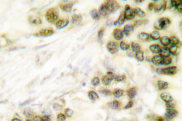 IHC of AP-2/ (K431) pAb in paraffin-embedded human lung carcinoma tissue.