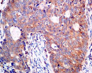 IHC of paraffin-embedded human colon carcinoma tissue using anti-AP2S1 antibody.