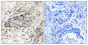 IHC of paraffin-embedded human lung carcinoma tissue, using APBA2 Antibody. The sample on the right was incubated with synthetic peptide.