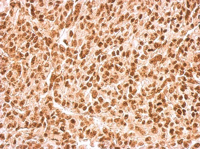APE1 antibody [N1], N-term detects APEX1 protein at nucleus on Saos2 xenograft by immunohistochemical analysis. Sample: Paraffin-embedded Saos2 xenograft. APE1 antibody [N1], N-term dilution:1:500.