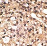 Formalin-fixed and paraffin-embedded human cancer tissue reacted with the primary antibody, which was peroxidase-conjugated to the secondary antibody, followed by DAB staining. This data demonstrates the use of this antibody for immunohistochemistry; clinical relevance has not been evaluated. BC = breast carcinoma; HC = hepatocarcinoma.