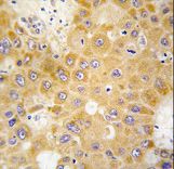 Formalin-fixed and paraffin-embedded human hepatocarcinoma tissue reacted with APH1 antibody , which was peroxidase-conjugated to the secondary antibody, followed by DAB staining. This data demonstrates the use of this antibody for immunohistochemistry; clinical relevance has not been evaluated.