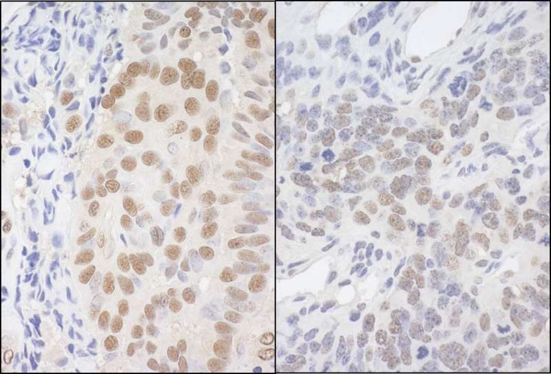 Detection of Human and Mouse API5 by Immunohistochemistry. Sample: FFPE section of human breast carcinoma (left) and mouse teratoma (right). Antibody: Affinity purified rabbit anti-API5 used at a dilution of 1:5000 (0.2 ug/mg).