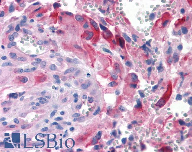 Anti-APLNR/ Apelin Receptor / APJ antibody IHC of human Brain, Glioblastoma. Immunohistochemistry of formalin-fixed, paraffin-embedded tissue after heat-induced antigen retrieval.