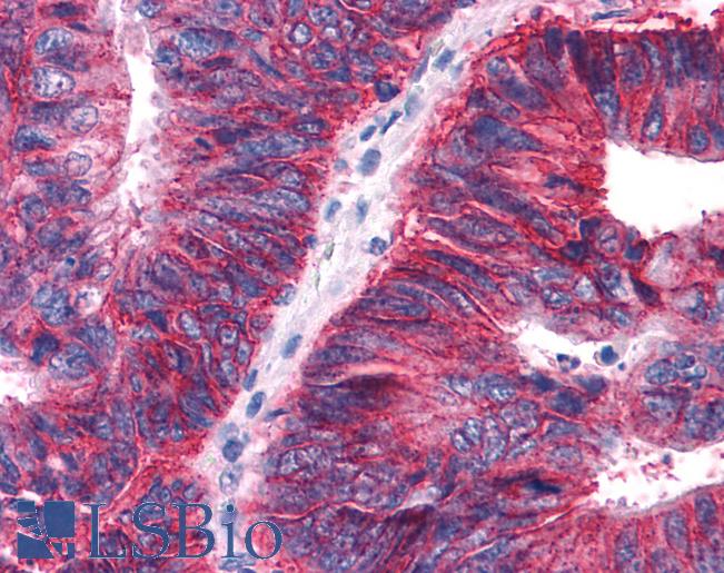 Anti-APLNR/ Apelin Receptor / APJ antibody IHC of human Colon, Carcinoma. Immunohistochemistry of formalin-fixed, paraffin-embedded tissue after heat-induced antigen retrieval.