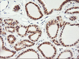IHC of paraffin-embedded Carcinoma of Human thyroid tissue using anti-C20orf3 mouse monoclonal antibody.