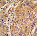 Formalin-fixed and paraffin-embedded human hepatocarcinoma tissue reacted with APOA1 antibody , which was peroxidase-conjugated to the secondary antibody, followed by DAB staining. This data demonstrates the use of this antibody for immunohistochemistry; clinical relevance has not been evaluated.