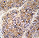 Formalin-fixed and paraffin-embedded human hepatocarcinoma tissue reacted with APOA2 antibody , which was peroxidase-conjugated to the secondary antibody, followed by DAB staining. This data demonstrates the use of this antibody for immunohistochemistry; clinical relevance has not been evaluated.
