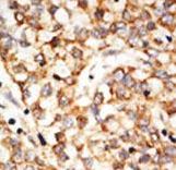 Formalin-fixed and paraffin-embedded human cancer tissue reacted with the primary antibody, which was peroxidase-conjugated to the secondary antibody, followed by DAB staining. This data demonstrates the use of this antibody for immunohistochemistry; clinical relevance has not been evaluated. BC = breast carcinoma; HC = hepatocarcinoma.