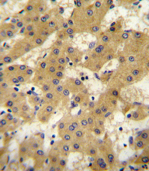 APOF antibody immunohistochemistry of formalin-fixed and paraffin-embedded human hepatocarcinoma followed by peroxidase-conjugated secondary antibody and DAB staining.