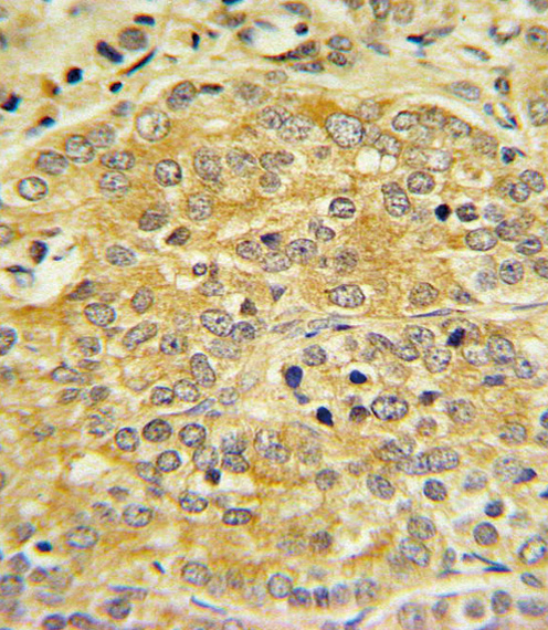 APOL1 Antibody IHC of formalin-fixed and paraffin-embedded human Prostate carcinoma followed by peroxidase-conjugated secondary antibody and DAB staining.
