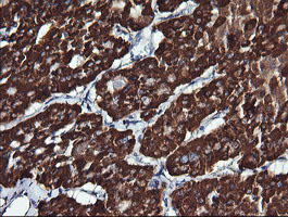 IHC of paraffin-embedded Carcinoma of Human thyroid tissue using anti-ACAA2 mouse monoclonal antibody.