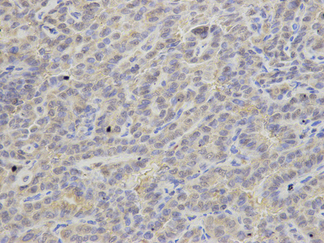 Immunohistochemistry of paraffin-embedded human thyroid cancer using APRT antibody at dilution of 1:200 (400x lens).