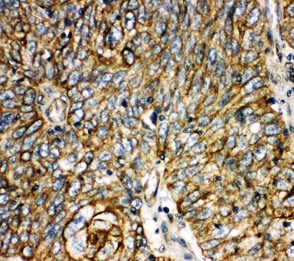 AQP6 / Aquaporin 6 antibody. IHC(P): Human Lung Cancer Tissue.