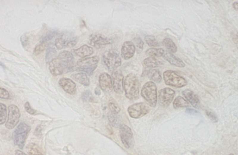 Detection of Human IBP160 by Immunohistochemistry. Sample: FFPE section of human ovarian carcinoma. Antibody: Affinity purified rabbit anti-IBP160 used at a dilution of 1:250.