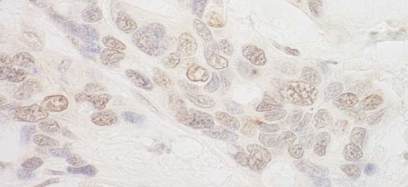 Detection of Human IBP160 by Immunohistochemistry. Sample: FFPE section of human ovarian carcinoma. Antibody: Affinity purified rabbit anti-IBP160 used at a dilution of 1:200 (1 ug/ml). Detection: DAB.