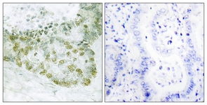 IHC of paraffin-embedded human lung carcinoma tissue, using Hic-5 Antibody. The sample on the right was incubated with synthetic peptide.