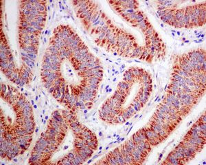 IHC of paraffin-embedded human colonic carcinoma tissue using anti-ACAA2 antibody.