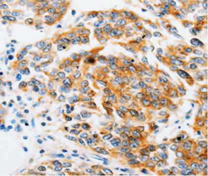 Immunohistochemistry of paraffin-embedded human breast cancer tissue using ARF6 antibody.