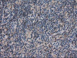 IHC of paraffin-embedded Human lymphoma tissue using anti-ARFGAP1 mouse monoclonal antibody.