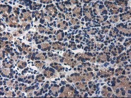 IHC of paraffin-embedded Carcinoma of Human thyroid tissue using anti-ARFGAP1 mouse monoclonal antibody.