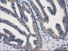 IHC of paraffin-embedded Carcinoma of Human prostate tissue using anti-ARFGAP1 mouse monoclonal antibody.