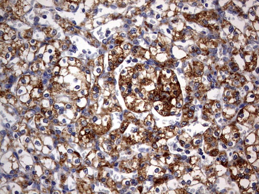 IHC of paraffin-embedded Carcinoma of Human kidney tissue using anti-ARL3 mouse monoclonal antibody. (Heat-induced epitope retrieval by 10mM citric buffer, pH6.0, 120°C for 3min).