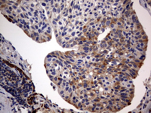 IHC of paraffin-embedded Carcinoma of Human lung tissue using anti-ARL3 mouse monoclonal antibody. (Heat-induced epitope retrieval by 10mM citric buffer, pH6.0, 120°C for 3min).