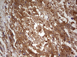 IHC of paraffin-embedded Adenocarcinoma of Human ovary tissue using anti-ARL3 mouse monoclonal antibody. (Heat-induced epitope retrieval by 10mM citric buffer, pH6.0, 120°C for 3min).