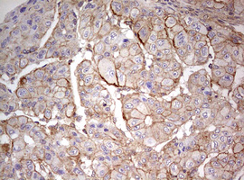 IHC of paraffin-embedded Carcinoma of Human liver tissue using anti-ARL3 mouse monoclonal antibody. (Heat-induced epitope retrieval by 10mM citric buffer, pH6.0, 120°C for 3min).