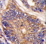 Formalin-fixed and paraffin-embedded human colon carcinoma tissue reacted with LDLRAP1 antibody , which was peroxidase-conjugated to the secondary antibody, followed by DAB staining. This data demonstrates the use of this antibody for immunohistochemistry; clinical relevance has not been evaluated.