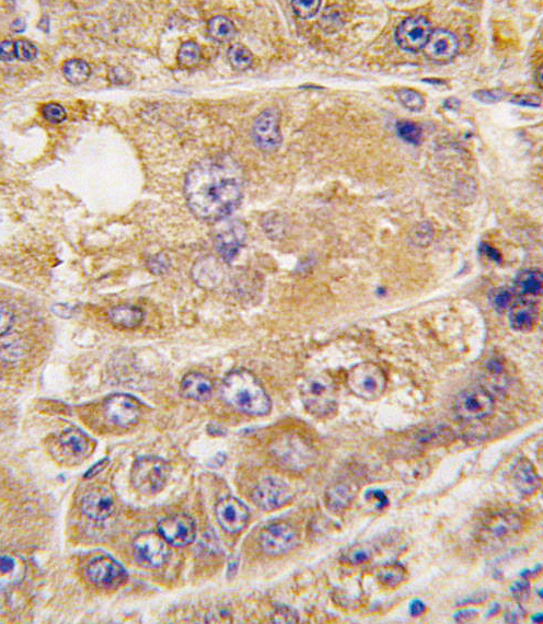 Formalin-fixed and paraffin-embedded human hepatocarcinoma tissue reacted with LDLRAP1 antibody , which was peroxidase-conjugated to the secondary antibody, followed by DAB staining. This data demonstrates the use of this antibody for immunohistochemistry; clinical relevance has not been evaluated.