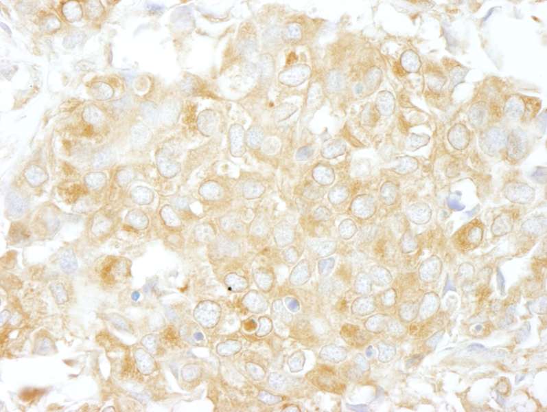 Detection of Human Cdc42GAP by Immunohistochemistry. Sample: FFPE section of human breast carcinoma. Antibody: Affinity purified rabbit anti-Cdc42GAP used at a dilution of 1:200 (1 ug/ml).