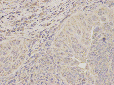Immunohistochemistry of paraffin-embedded human endometrial cancer using ACAT1 antibody at dilution of 1:200 (400x lens).