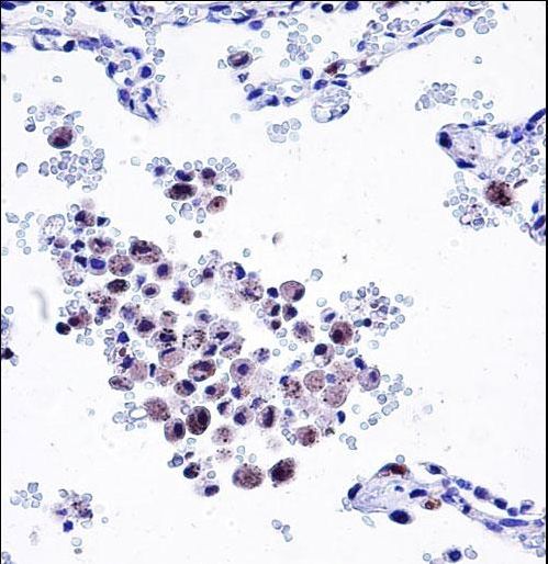 ARHGDIB Antibody immunohistochemistry of formalin-fixed and paraffin-embedded human lung tissue followed by peroxidase-conjugated secondary antibody and DAB staining.
