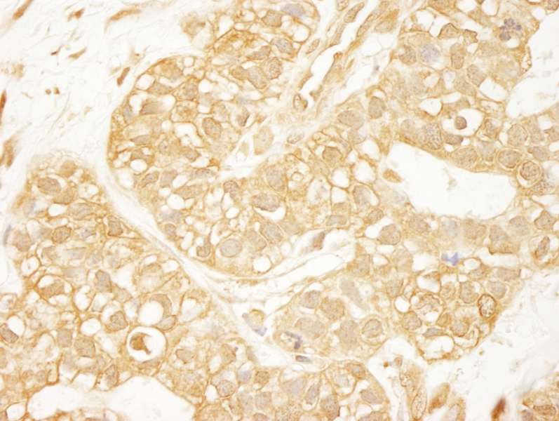 Detection of Human PDZ-RhoGEF by Immunohistochemistry. Sample: FFPE section of human breast carcinoma. Antibody: Affinity purified rabbit anti-PDZ-RhoGEF used at a dilution of 1:1000 (1 ug/ml). Detection: DAB.