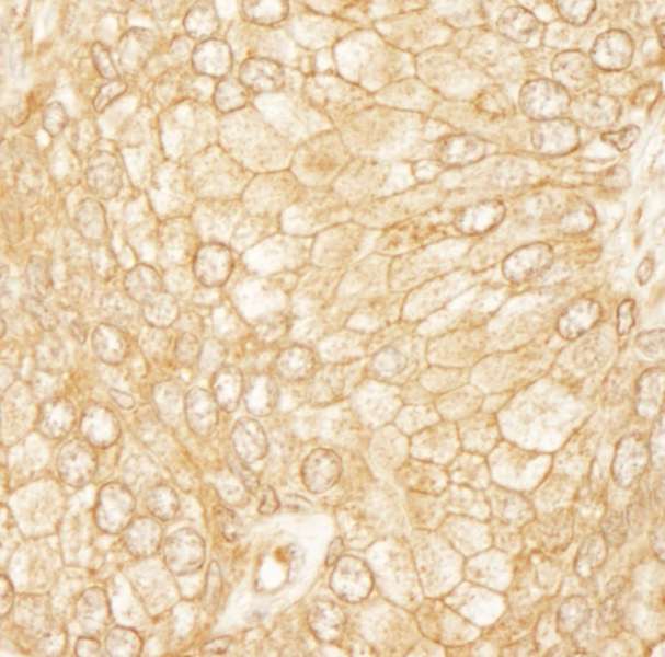 Detection of Human PDZ-RhoGEF by Immunohistochemistry. Sample: FFPE section of human prostate carcinoma. Antibody: Affinity purified rabbit anti-PDZ-RhoGEF used at a dilution of 1:200 (1 ug/ml). Detection: DAB.