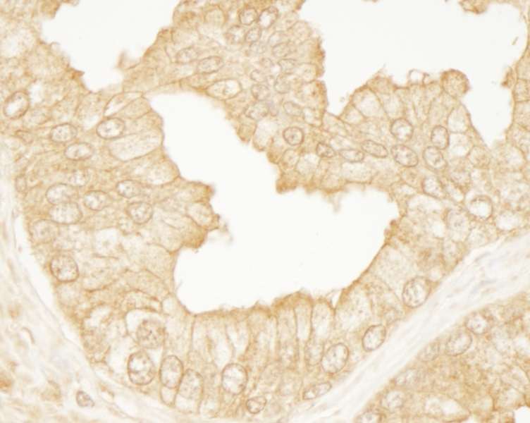 Detection of Human PDZ-RhoGEF by Immunohistochemistry. Sample: FFPE section of human prostate carcinoma. Antibody: Affinity purified rabbit anti-PDZ-RhoGEF used at a dilution of 1:100.